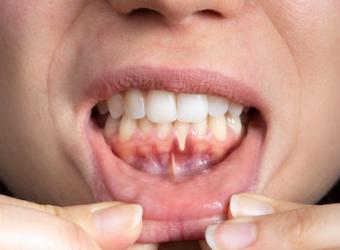 Gum Recession: Where did my gums go?